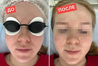 Карбоновый пилинг для лица ДО и ПОСЛЕ